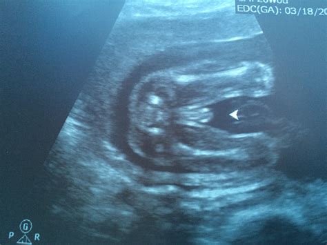 how accurate are dating scans at 9 weeks